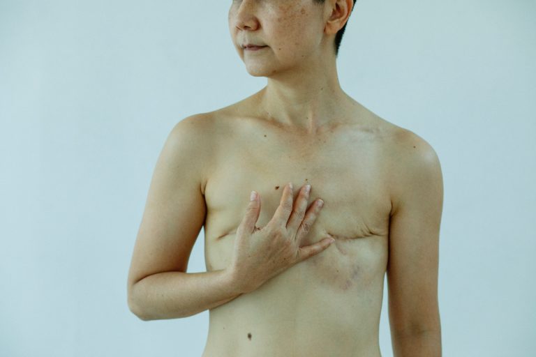 Read more about the article Metastatic Breast Cancer: Causes, Symptoms, and Treatments