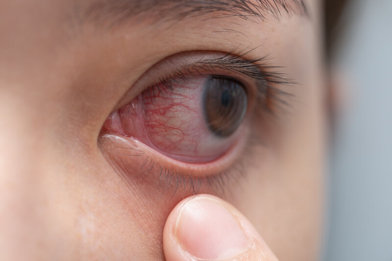 Read more about the article Herpes in the Eye: What You Need to Know to Protect Your Vision