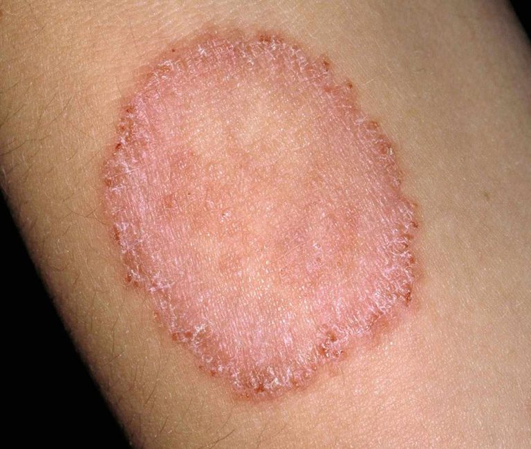 Read more about the article What is Ringworm and How to Identify It?